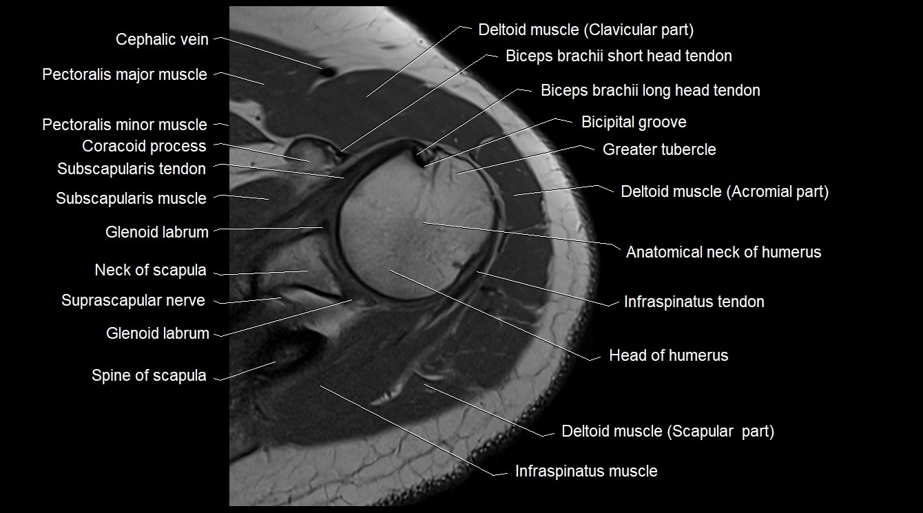Upper arm( humerus) cross section anatomy MRI 3T axial image 10.webp